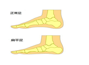 扁平足.PNG